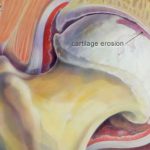 Hip Joint Cartilage Erosion