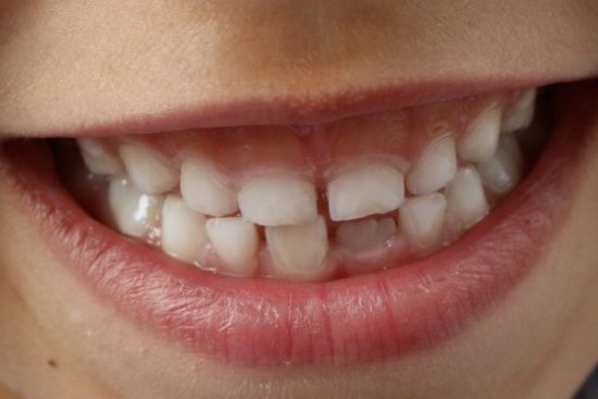 Best Ways to Fix Gapped Teeth